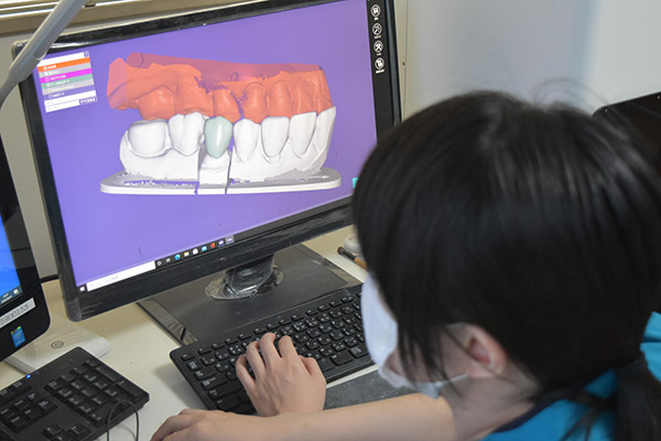 CAD/CAM冠とは